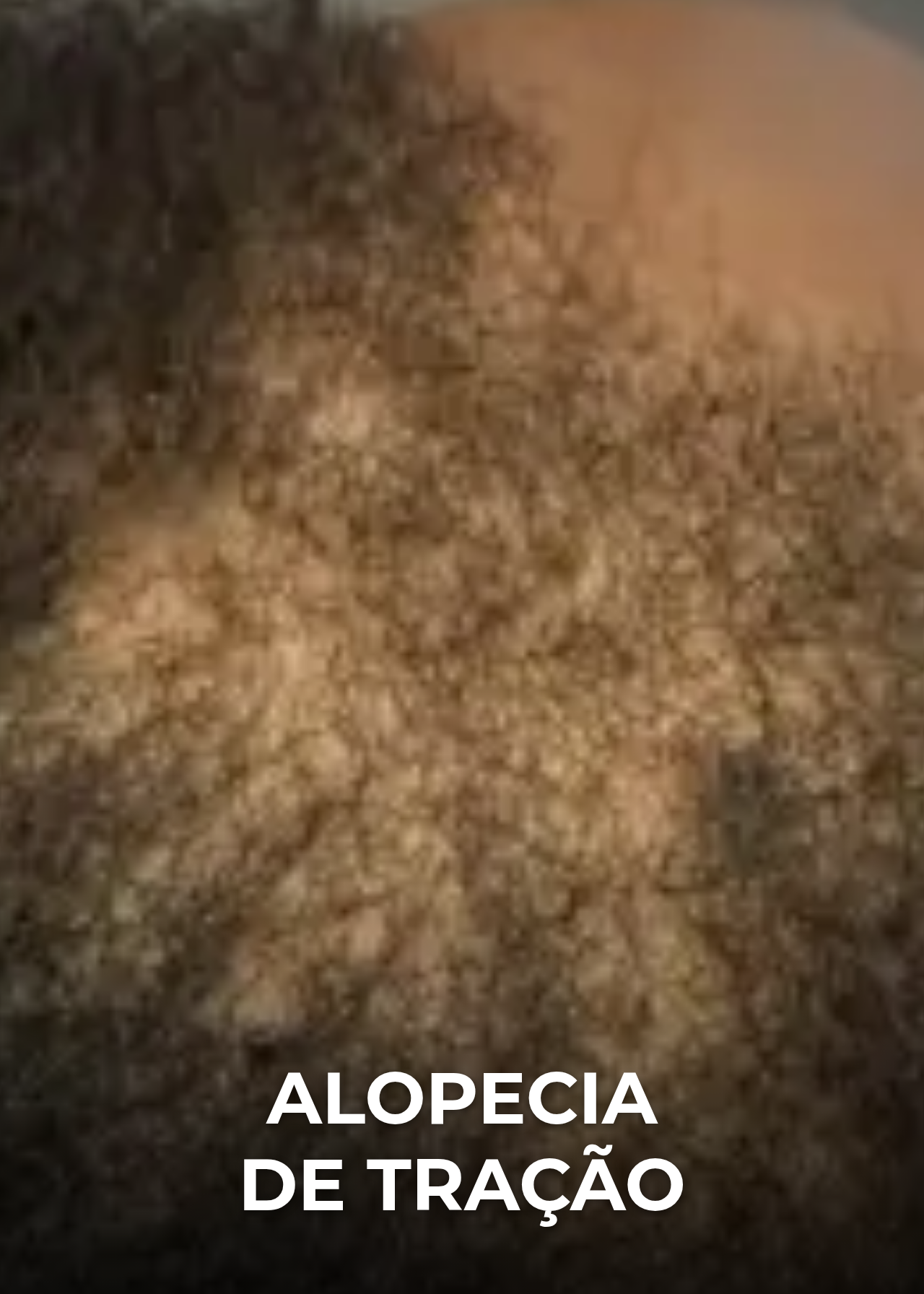 Alopecia de tração