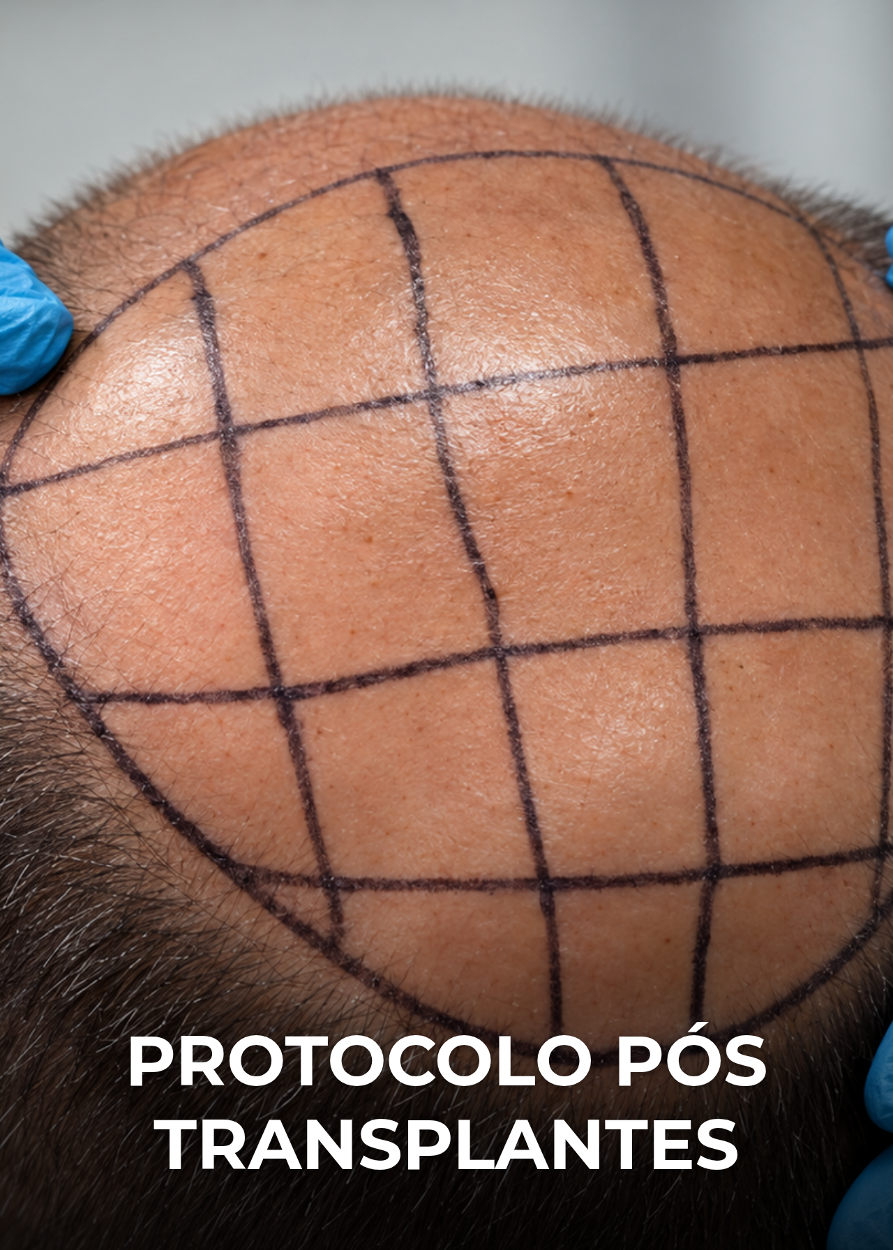Protocolo pós-transplantes