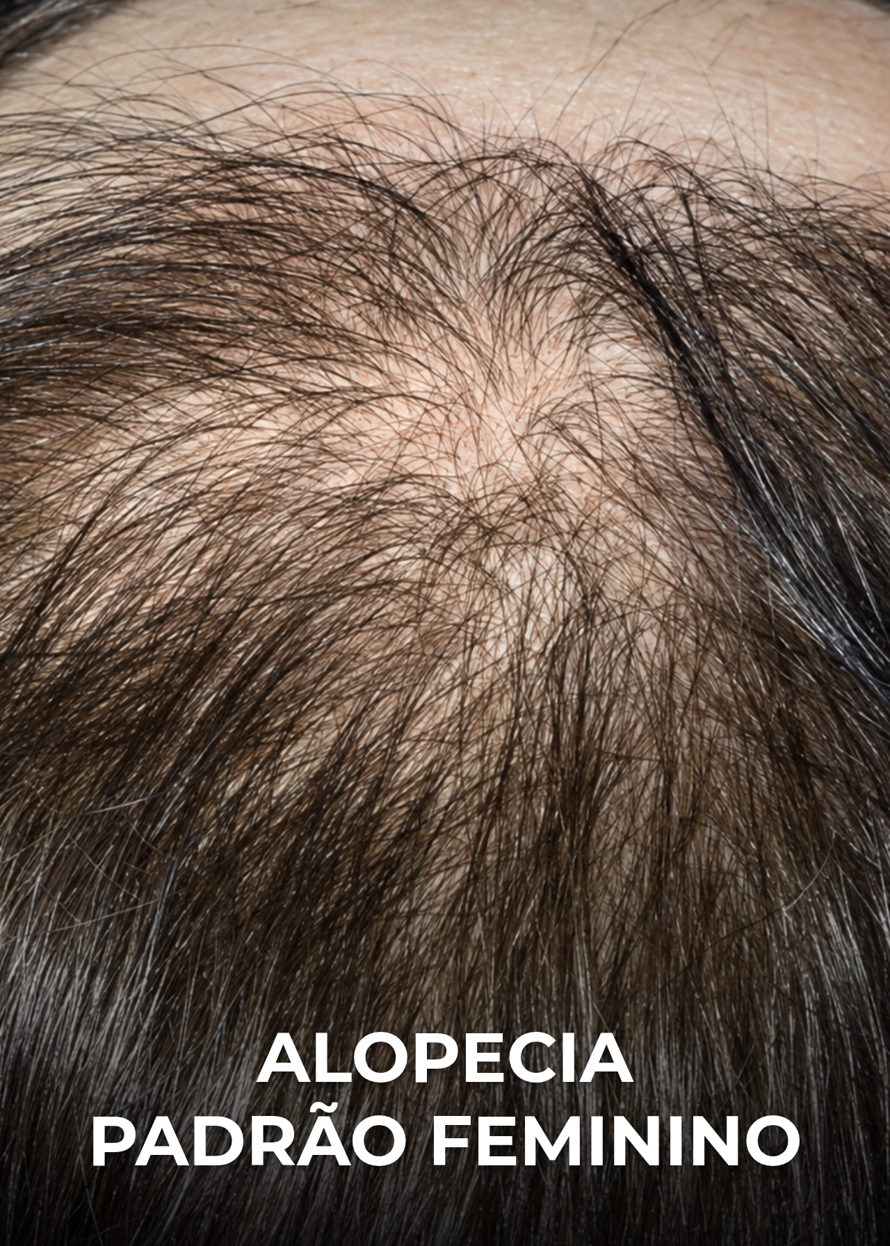 Alopecia padrão feminino