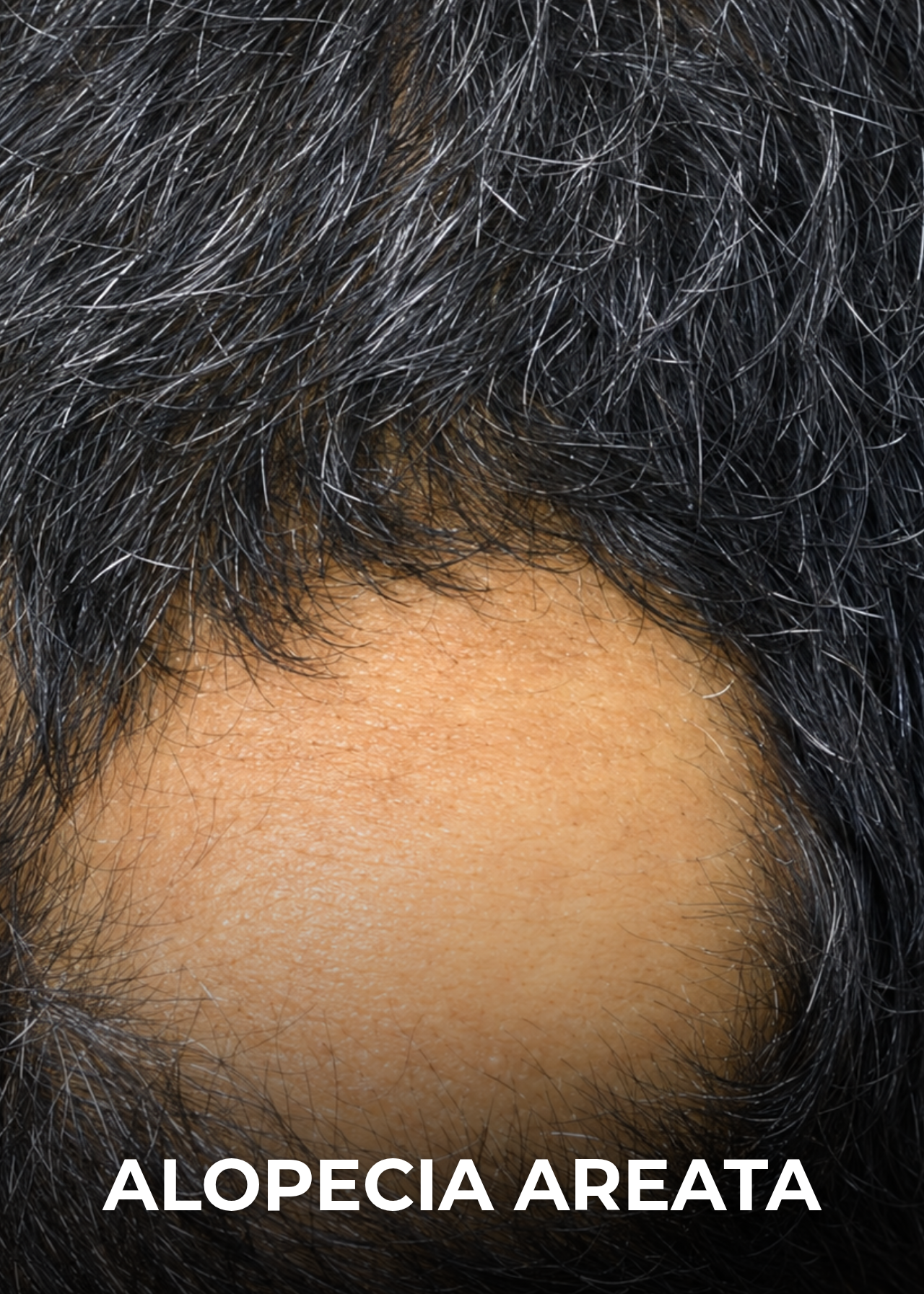 Alopecia areata