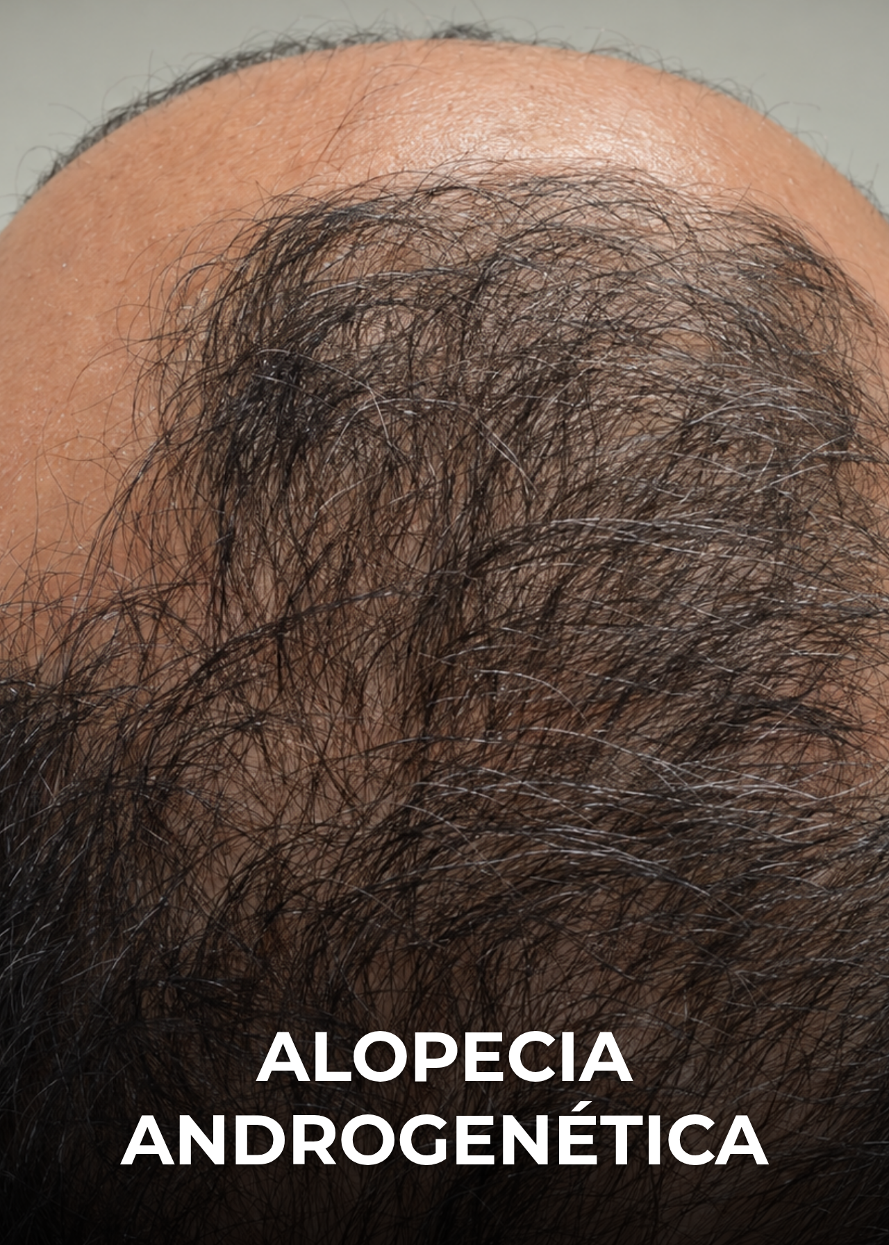 Alopecia androgenética
